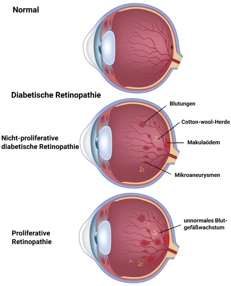 Diabetische Retinopathie Zuckerbedingte Netzhauterkrankung Aumedo