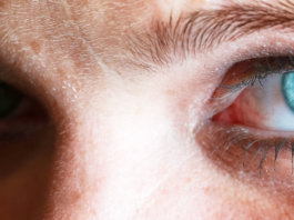 Die Schuppenflechte im Auge kann mit Augenproblemen korrelieren