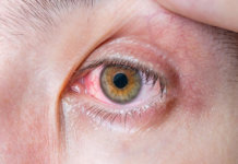 Uveitis: Warum eine frühzeitige Behandlung wichtig ist