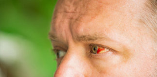 Geplatzte Ader im Auge (Hyposphagma) – Ursachen, Symptome und Behandlung Bindehautunterblutung