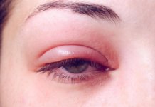 Lidrandentzündung (Blepharitis): Symptome, Ursachen & Behandlung Lidrandentzündung