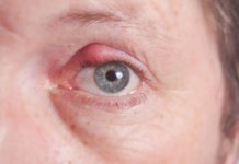 Hagelkorn (Chalazion): Ursache, Symptome & Therapie Hagelkorn (Chalazion)