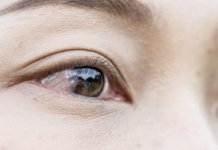Der Lidspaltenfleck (Pinguecula): Gelbliche Verdickung der Bindehaut Pinguecula (Lidspaltenfleck)