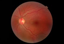 Fundusfotografie: Fotoverlaufskontrolle des Augenhintergrunds Fundusfotografie: Fotoverlaufskontrolle des Augenhintergrunds