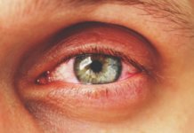 Bindehautentzündung: Symptome, Ursachen & Therapie Bindehautentzündung (Konjunktivitis)