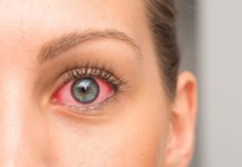 Was tun, wenn die Bindehaut entzündet ist? Bindehautentzündung: Was steckt dahinter?