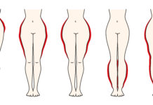 Was hilft gegen Lipödem?